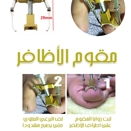 مقوم الاظفر بدون جراحة