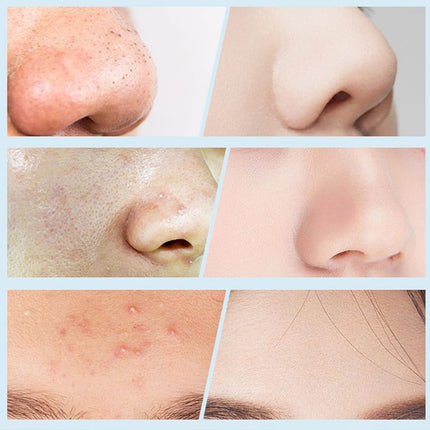 جهاز إزالة الزيوان والرؤوس السوداء visual blackhead instrument