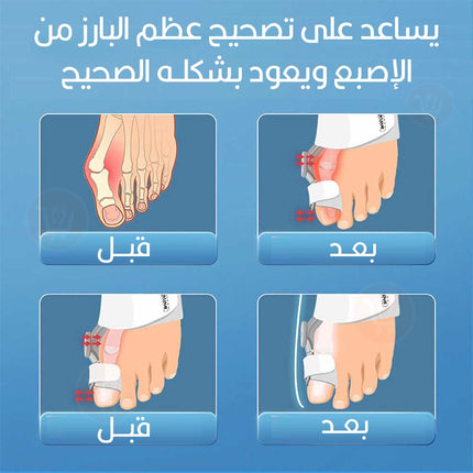 مصحح لتعديل أصبع القدم (الإبهام) Bunnion corrector