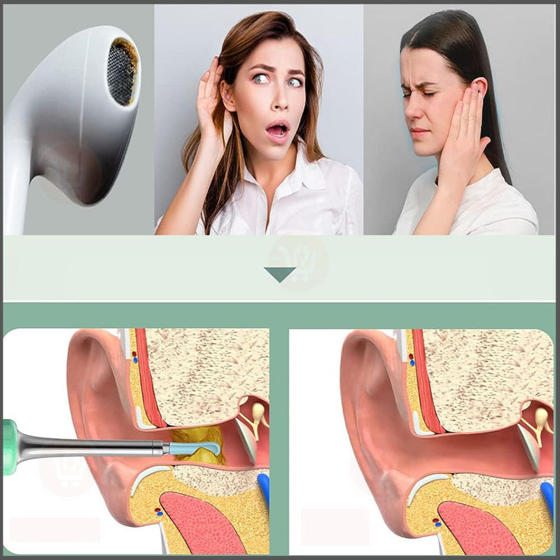 منظار (كاميرا) إزالة شمع الأذن  OTOSCOPE Ear Wax Removal Endoscope