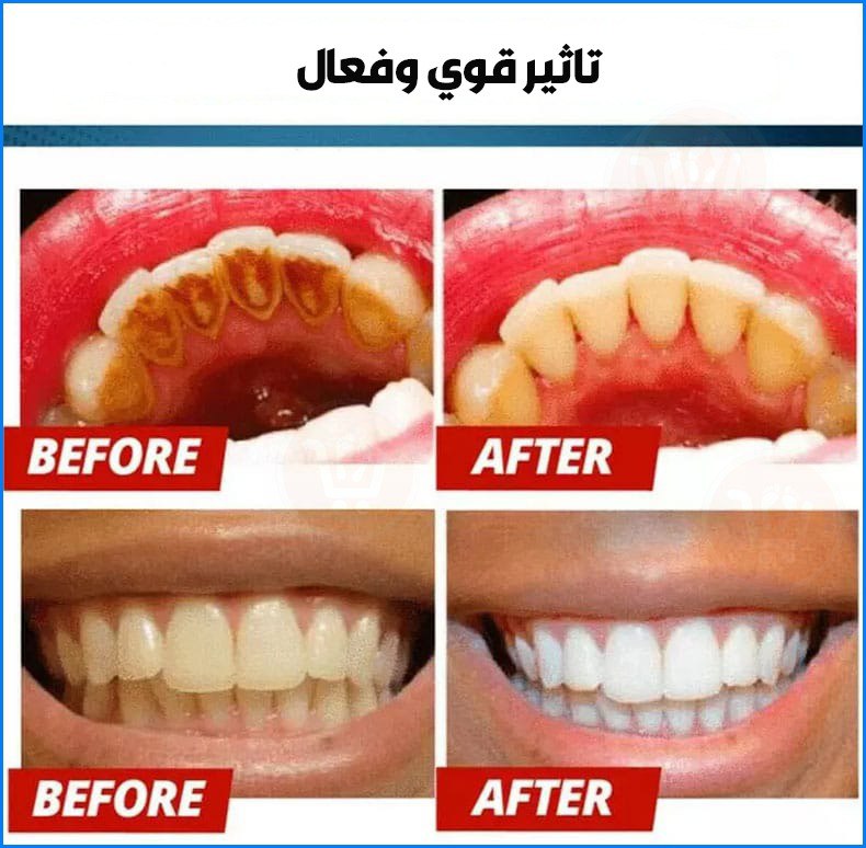 معجون تبيض الأسنان الفعال