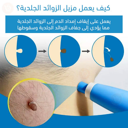 قلم إزالة الثواليل والزوائد الجلدية