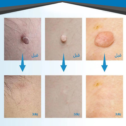 قلم إزالة الثواليل والزوائد الجلدية