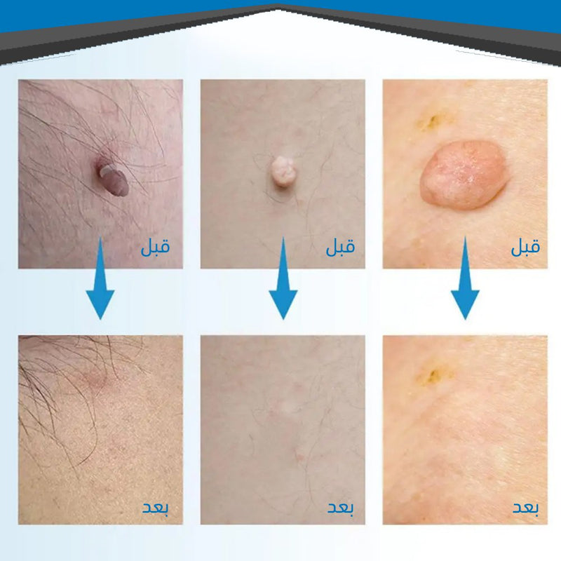قلم إزالة الثواليل والزوائد الجلدية