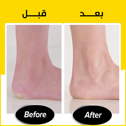 مزيل الجلد الميت مـن القدمين يعمل بالشحن Callus Remover for Feet
