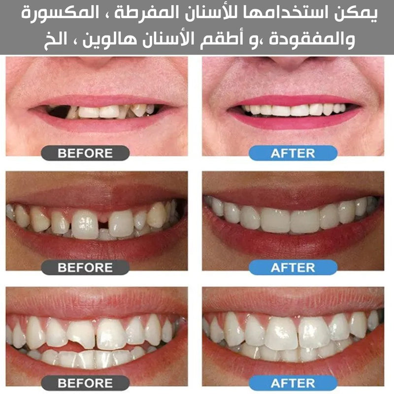 معجون حشوات الراتنج للأسنان moldable false teeth