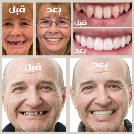 طقم اسنان متحرك