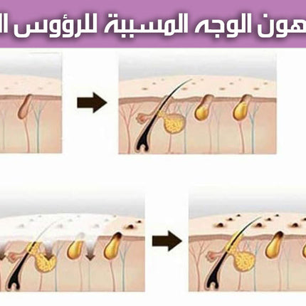 جهاز ازالة الزيوان والرؤوس السوداءELECTRIC BLACKHEAD REMOVER