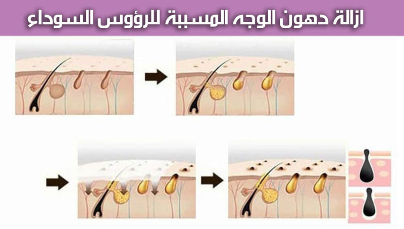 جهاز ازالة الزيوان والرؤوس السوداءELECTRIC BLACKHEAD REMOVER